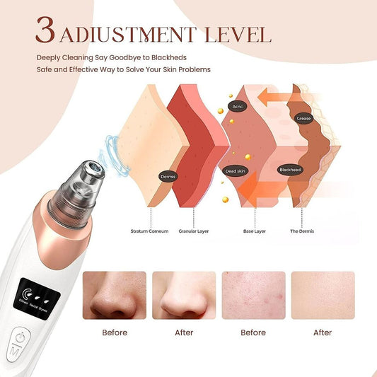 Blackhead Remover Pore Vacuum | Vaccum Acne Pimple, Black Spot Suction Electric Facial Pore Cleaner Skincare – 5 Suction Power, 5 Probes – Usb Rechargeable